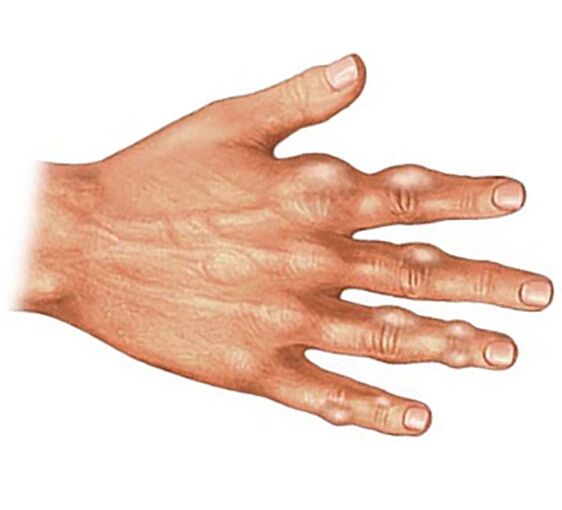 Gut artritli parmakların yumuşak dokularında ürik asit kristallerinin birikmesi