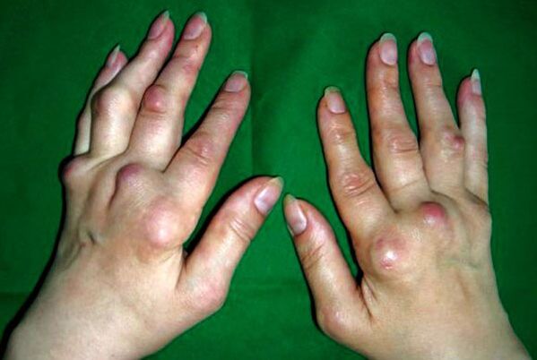 Poliosteoartrit deformansından etkilenen eller