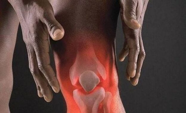 Artroz, diz ekleminde inflamatuar bir süreçle birlikte görülür. 